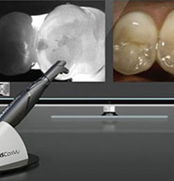 INTRA-ORAL CAMERA used in Dental Office West Chester, PA
