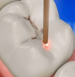 EVERYTHING YOU NEED TO KNOW ABOUT LASER DENTISTRY