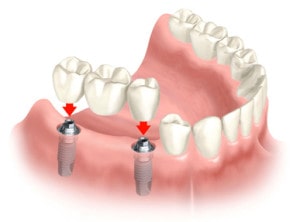 Dental Implants West Chester, PA