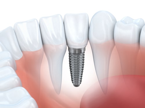 Dental Implants Downingtown, PA