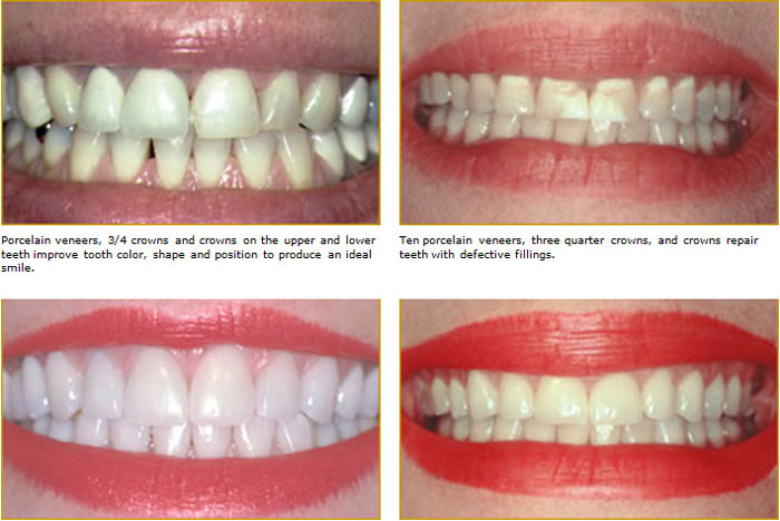 Veneers that Match your Natural Teeth West Chester, PA