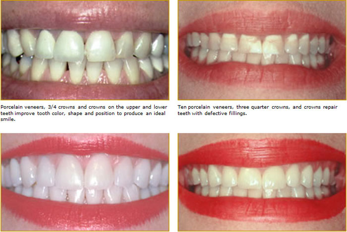 porcelain veneers West Chester, PA