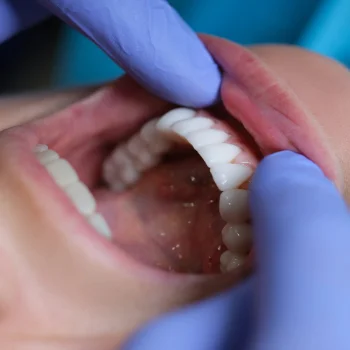 A dentist showing porcelain veneers in a woman's mouth in Downingtown, PA